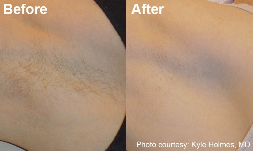 Laser hair removal | Mint Laser & Beauty